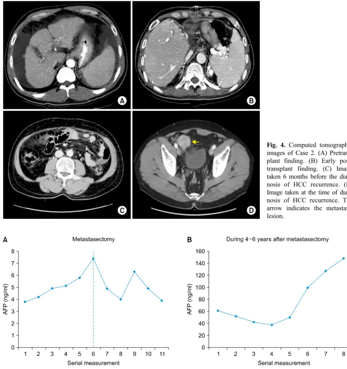 Fig. 4. Computed tomographic  images of Case 2. (A)  Pretrans-plant finding. (B) Early post-  transplant finding