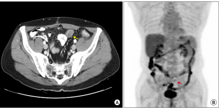 Fig. 6. Positron emission tomography analysis of Case 2  showing a mass with hypermetabolic uptake (arrow).