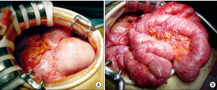Fig. 2. On laparotomy, the small intestine appears to be encapsulated with a fibrous peel (A)