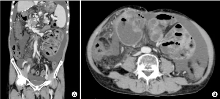 Fig. 5. Abdominal CT reveals ascites, splenomegaly, and portal vein thrombosis with collateral veins (A)