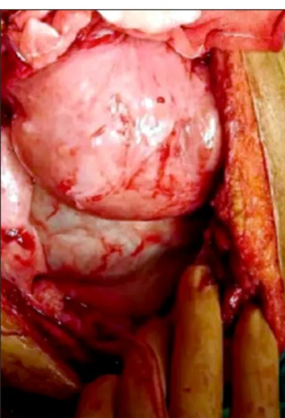 Fig. 7. Thick fibrotic peel wrapping loops of small bowel.