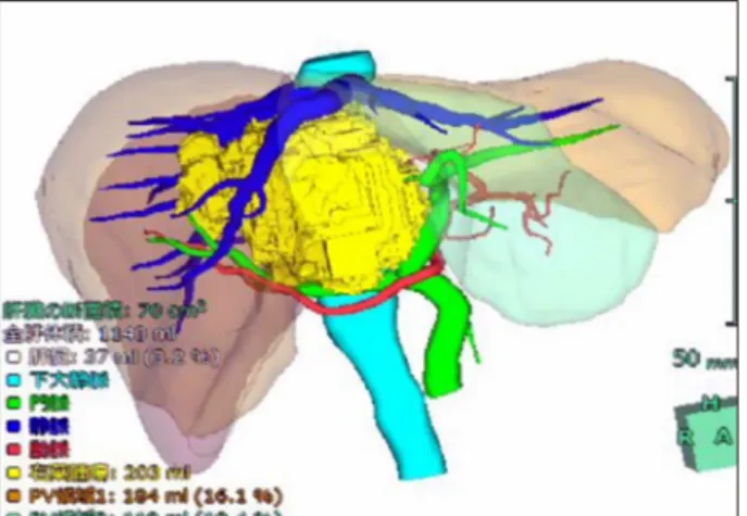 Fig. 8. Sagittal computed tomography before (A) and after (B) percutaneous transhepatic portal vein embolization.