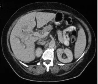 Fig. 2. Photograph of the resected specimen after extended  right hepatectomy. The segment IVa was spared
