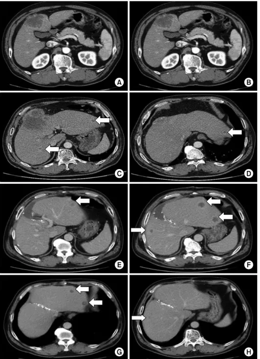 Fig. 1. Pre- and postoperative  computed tomography (CT)  scan findings. Preoperative CT  scan showed that the initial  tu-mor diameter was 6.3 cm (A)
