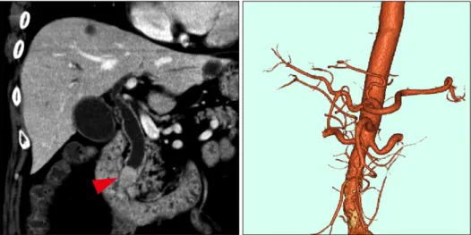 Fig. 1. Computed tomography  findings showing tumor of the  lower bile duct with biliary  di-latation (arrow).