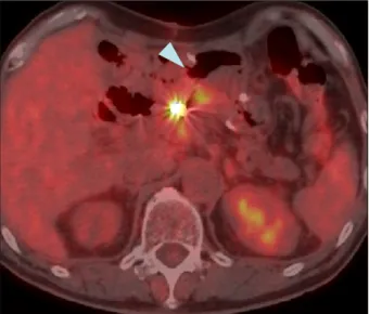 Fig. 6. Positron emission tomography computed tomography show- show-ing hypermetabolic uptake indicatshow-ing recurrence (arrow).