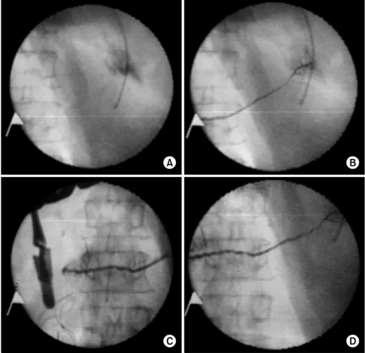 Fig. 1. Intraoperative fluoro- fluoro-scopy: the procedure begins with  the embolization of the distal  part of the duct (A), continues  to the body (B) and up to the  stump (C)