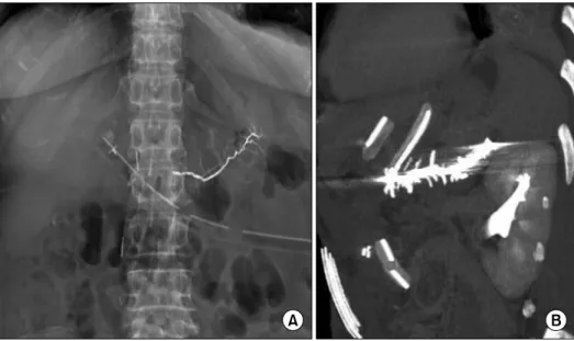 Fig. 2. (A) X-ray and (B) ab- ab-dominal computed tomography  scan at the 7 th  postoperative day  shows the pancreatic mold,  cor-relatable to successful  emboli-zation of the main pancreatic  duct and its secondary branches
