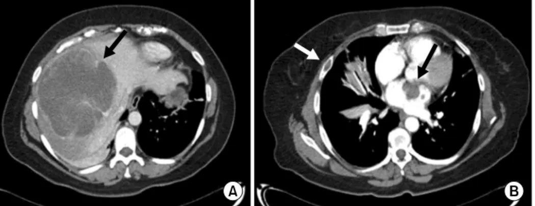 Fig. 1. Computed tomography with intravenous contrast showing a (A) right liver lobule with a 20 cm-sized hypodense lesion  (arrow) with irregular borders, a few septa, and centripetal reinforcement without any intra or extrahepatic biliary tract dilation