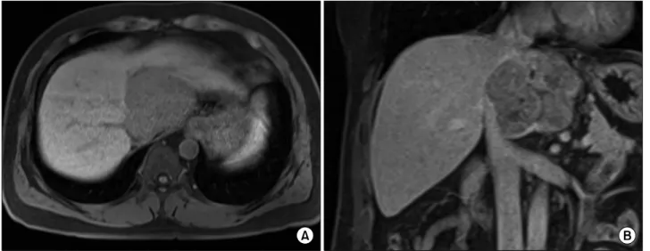 Fig. 4. Positron emission tomography showed a vague and  heterogeneously hypermetabolic mass.