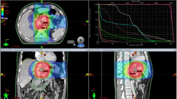 Fig. 7. CT simulation for stereotactic beam radiotherapy with avoidance of exposure to the gastric antrum.