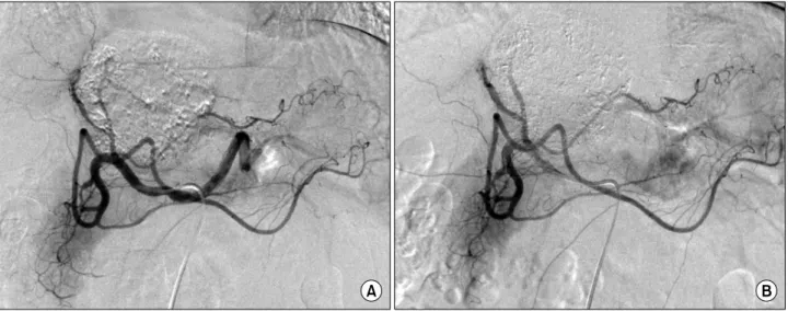 Fig. 9. Second session of transcatheter arterial chemoembolization shows suspicious tumor staining in both lobes (A) and post-em- post-em-bolization status.