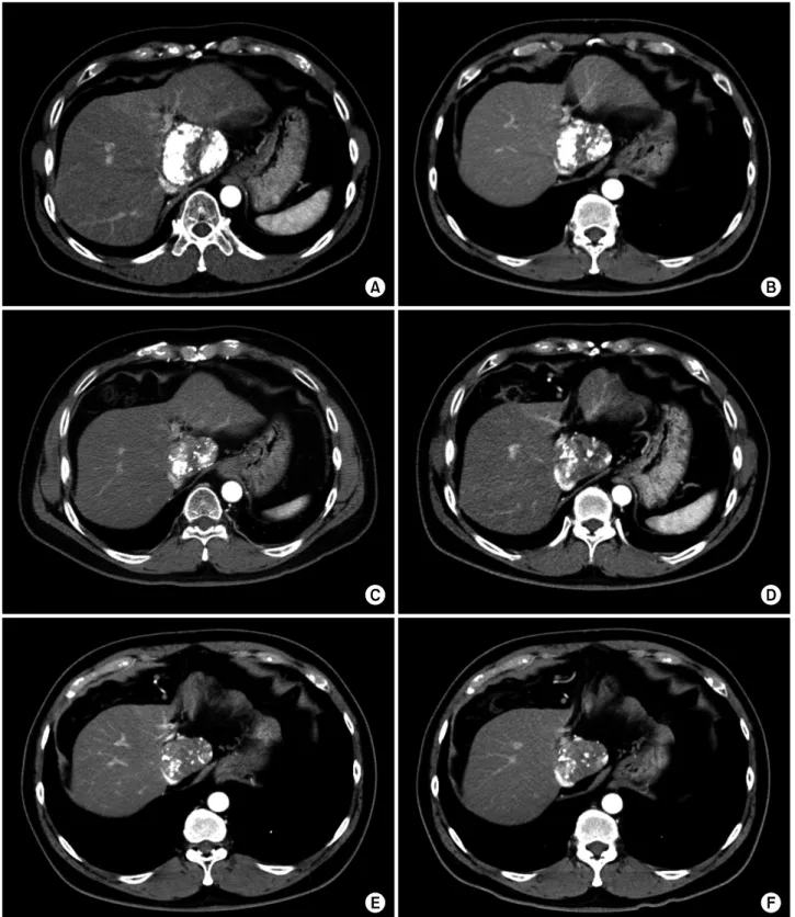 Fig. 10. Follow-up CT scans showing no changes of the partial lipiodolized lesion at the caudate lobe taken 1 month (A),  1 year (B), 2 years (C), 3 years (D), 4 years (E) and 5 years (F) after the second session of TACE.