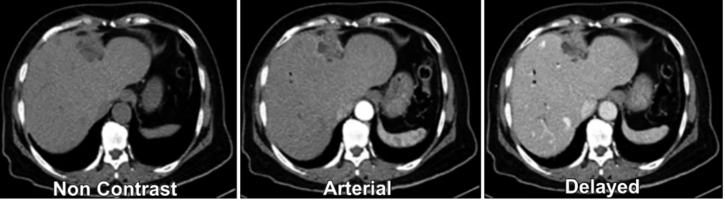 Fig. 1. Initial preoperative CT scan showing a multiple intra-ductal gradually enhancing lesions within the left intrahepatic duct.