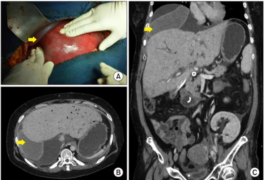 Fig. 1. (A) Intraoperative view  after placement of a single  bre-ast implant (yellow arrow)  be-tween the diaphragm and the  graft