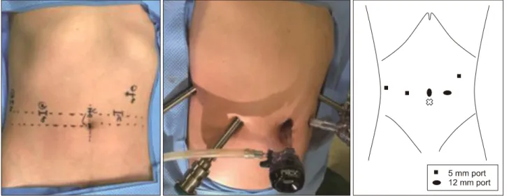 Fig. 1. Site and size of the trocars in robotic procedure.
