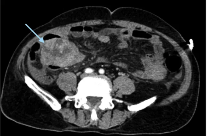 Fig. 1. Computed tomography showing a 5 cm-sized enhanc- enhanc-ing mass (arrow) in the right flank adherent to small bowel