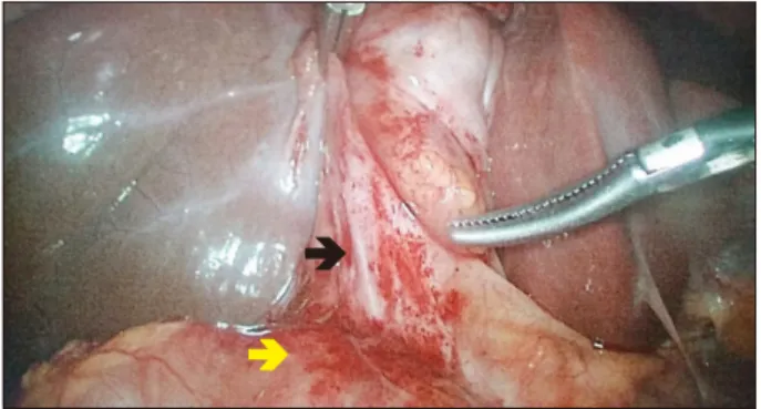 Fig. 4. The tissues became eudomatous after isotonic  instillation. The common bile duct (white arrow) was easily  separeted from the Hartman pouch of gallbladder (black  ar-row) with hydrodissection.