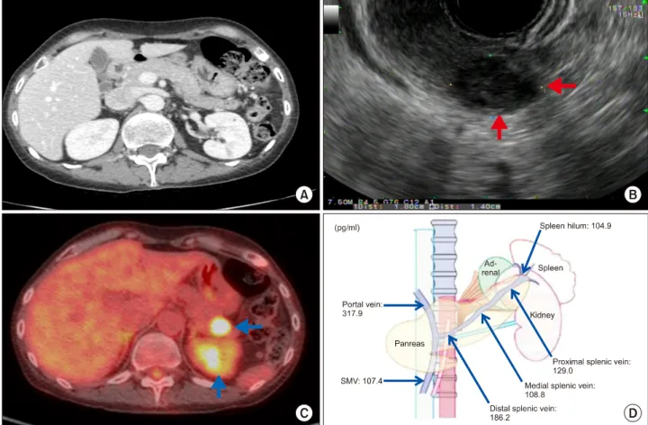 Fig. 2. Preoperative findings. (A) Adrenal Computed Tomography: No remarkable finding in both adrenal glands