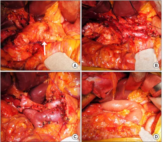 Fig. 1. Case 1 details. A  57-year-old male patient  under-going pylorus-preserving  pan-creaticoduodenectomy with  ex-tended pancreatic transection  technique for distal bile duct  cancer