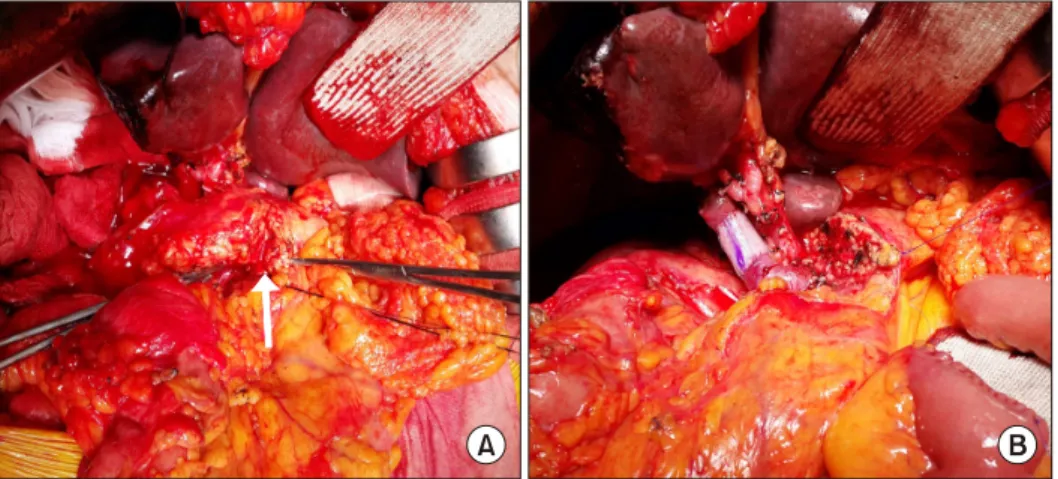 Fig. 2. Case 2 details. A 62-year-old male patient undergoing hepatopancreaticoduodenectomy including right hepatectomy, cau- cau-date lobectomy, pylorus-preserving pancreaticoduodenectomy with extended pancreatic transection technique, and portal vein  re