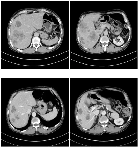 Fig. 1. Preoperative computed  tomography shows the largest  metastasis located at the  seg-ment 6, measuring 6.5 cm×5.5 cm×6 cm.