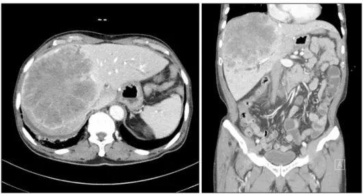 Fig. 7. Computed tomography  volumetry showed that the total liver volume was 2,044 ml and  the future liver remnant volume  was 385 ml (19% of the total  liver volume).