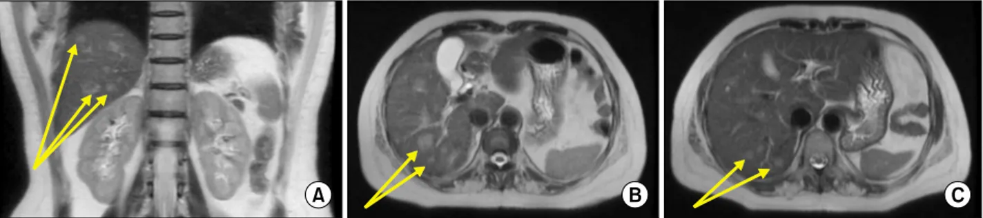 Fig. 2. Magnetic resonance imaging showing T2-weighted coronal section with multiple hyperintense lesions (A) and T2-weighted transverse cuts with multiple hyperintense lesions (B) and (C) in the right lobe.
