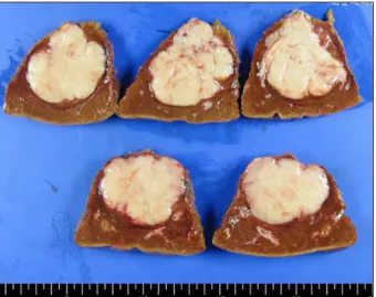 Fig. 5. Microscopic findings of the liver confirming non-Hodgkin’s diffuse large B-cell lymphoma