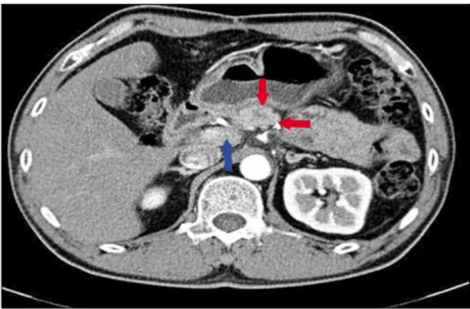 Fig. 4. Post-operation follow-up computed tomography scan  after 8 months, showed that the remaining pancreas had no  evidence of recurrence (red arrows)