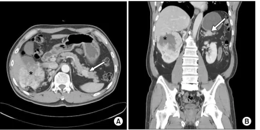 Fig. 3. Axial (A) and coronal (B)  contrast-enhanced computed  to-mography scan images show a  well-defined homogeneously  en-hanced mass in the tail of the  pancreas (arrow)