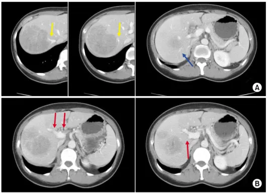Fig. 1. Preoperative computed  tomography scan shows a large  mass abutting the right hepatic  vein (yellow arrow) and the  right posterior portal vein (blue  arrow) (A) and type II portal  vein (red arrow) anomaly (B).