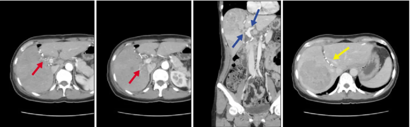 Fig. 3. Computed tomography scans 7 days after the first stage operation show intact right anterior and posterior hepatic arteries (red arrow), an adequately ligated right portal vein and a patent left portal vein (blue arrow), and a well-preserved middle 