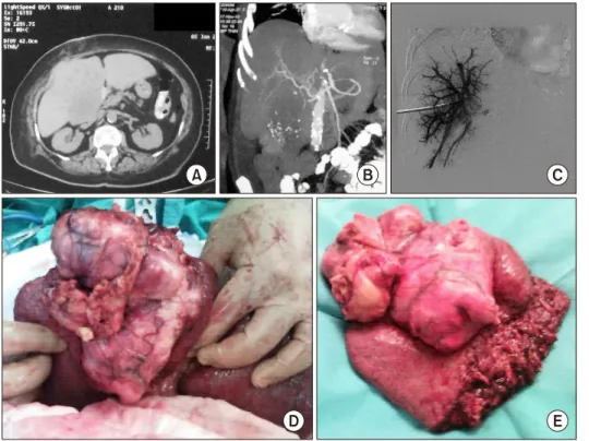 Fig. 1. (A and B) Abdominal  computed tomography (CT)  re-vealed a hypodense lesion (14  cm×11 cm) occupying segments IVA, V, VI and part 0f VII
