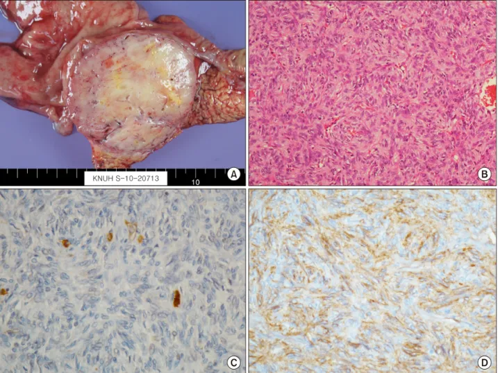 Fig. 2. Pathologic study findings. (A) On pathologic gross examination, the tumor measured at 7 cm in its greatest dimension involving the pancreatic head