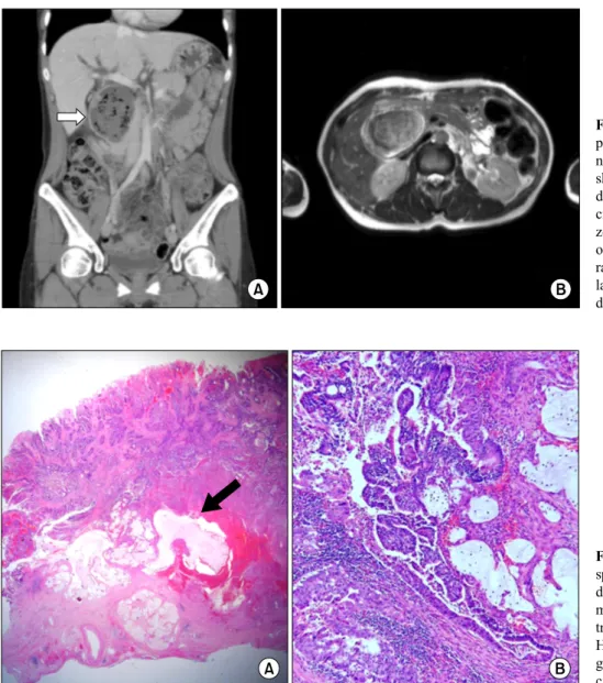 Fig. 1. Imaging studies of the  patient. (A) Patient’s  abdomi-no-pelvic computed tomogram  shows dilatation of intrahepatic  duct, pneumobilia, and a 6.8  cm×8.5 cm×5.0 cm-sized  be-zoar (arrow)