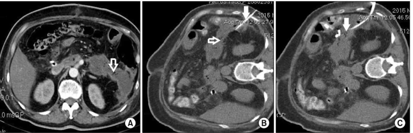 Fig. 3. Abdominal contrast-enhanced computed tomography axial slice in the venous phase performed on POD 30 showing (A) a large peripancreatic distal collection with gas inside suggesting the formation of a peripancreatic abscess (open white arrow);