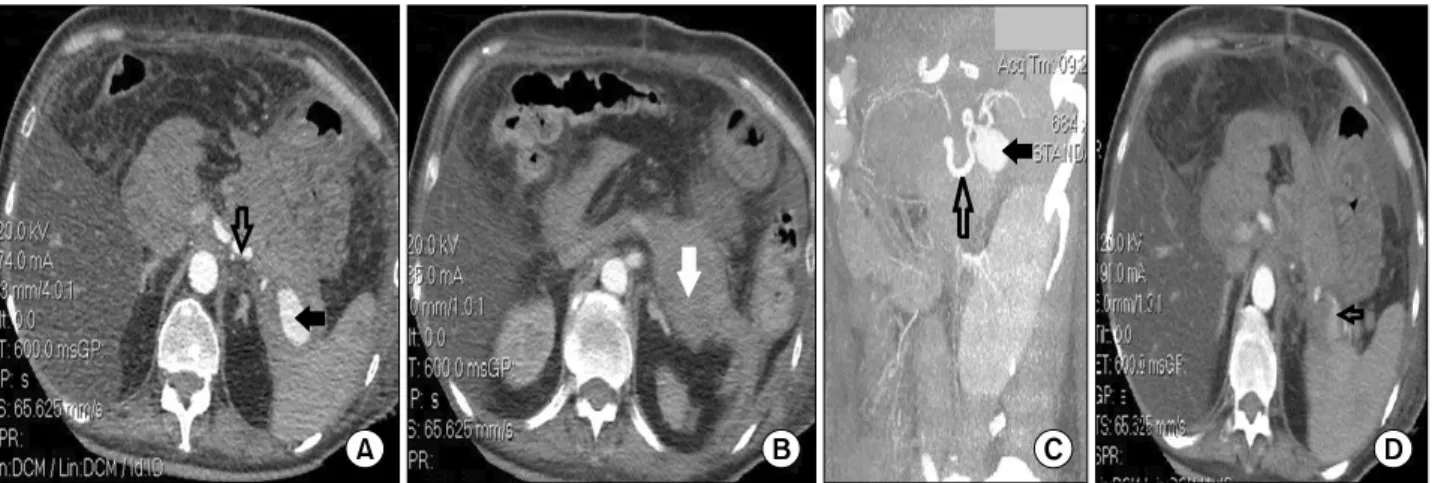 Fig. 5. Abdominal contrast-enhanced computed tomography in the arterial phase performed on POD 84 (A) axial slice showing a 3.2 cm×1.8 cm-sized pseudoaneurysm (filled black arrow) of the splenic artery (open black arrow); (B) axial slice showing  a high-de