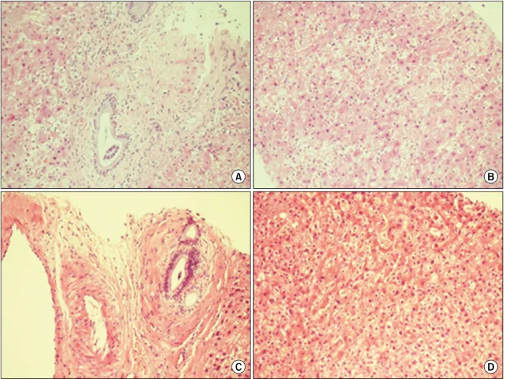 Fig. 4. Liver biopsy findings (H&amp;E ×200). (A) Periportal infiltration of a few periportal neutrophils and lymphocytes at POD 50, (B) zone 3 cholestasis and lobular hepatocyte necrosis consistent with DILI at POD 50, (C) periportal infiltration of extre