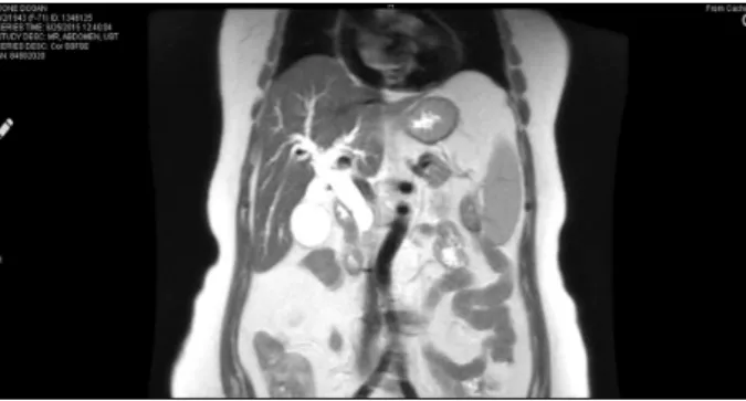 Fig. 2. Magnetic resonance cholangiopancreatography show- show-ing dlatation of the common bile duct and intrahepatic bile duct.