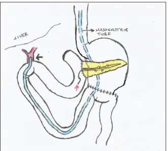 Fig. 6. A nasogastric tube is put into the anastomosis. A black arrow indicates hepaticojejunostomy anastomosis and a red  arrow indicates the internal catheter inside the Wirsung duct.