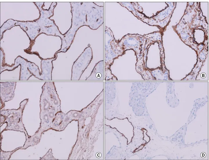Fig. 2. Immunohistochemical stain shows a cavernous, ectatic endothelial neoplasm arising amid pancreatic parenchymal tissue.