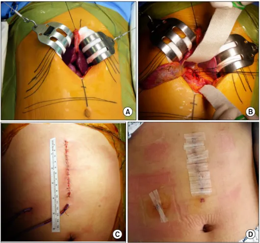 Fig. 2. Operative photographs of  upper midline mini-laparotomy  in a 32-year-old female patient