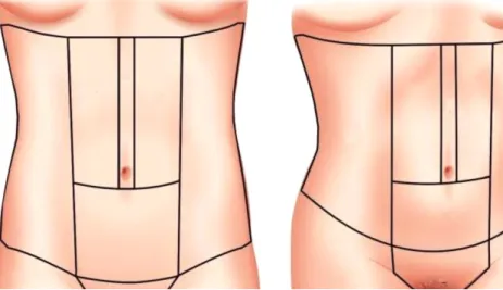 Fig. 3. Aesthetic subunits of the  abdominal region and adjacent  areas. The upper midline  in-cision is located at the upper  midline aesthetic subunit which  overlies the midline of the  abdomen