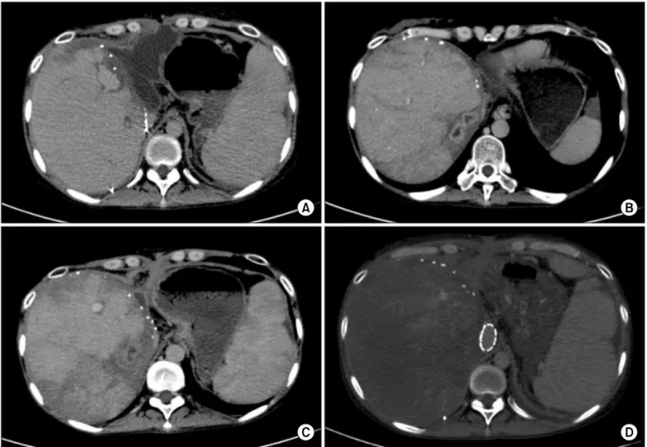 Fig. 1. Sequences of computed tomography (CT) findings: (A) CT scan shows biloma around the liver graft; (B) CT scan taken at day 73 shows multifocal liver abscesses; (C) CT scan shows treatment of liver abscess following antibiotics therapy; and  (D) CT s
