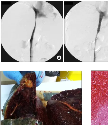 Fig. 2. Direct venography find- find-ings showing stenosis of the  ret-rohepatic inferior vena cava (A) and expansion after inferior  vena cava stenting (B).