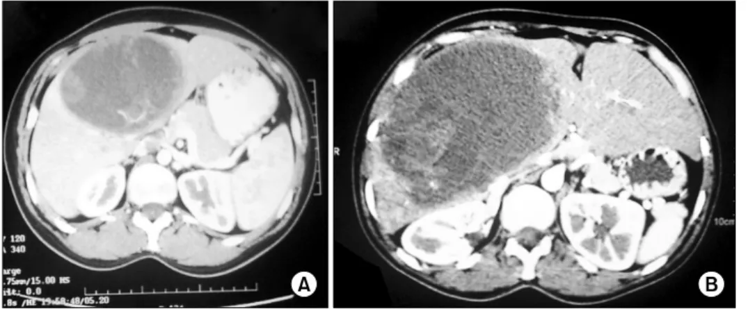 Fig. 1. Computed tomography  imaging before (A) and after  (B) portal vein embolization.