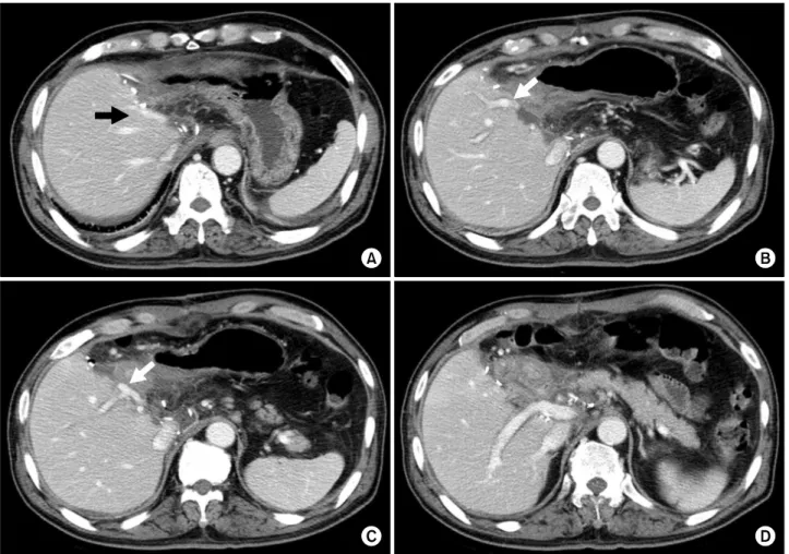 Fig. 5. Computed tomography images taken at 10 days after surgery. Two middle hepatic vein trunks are visible (A); The portal  vein branch to the theoretical left medial section is visible (arrow, B); The portal vein branch to the right anterior section is