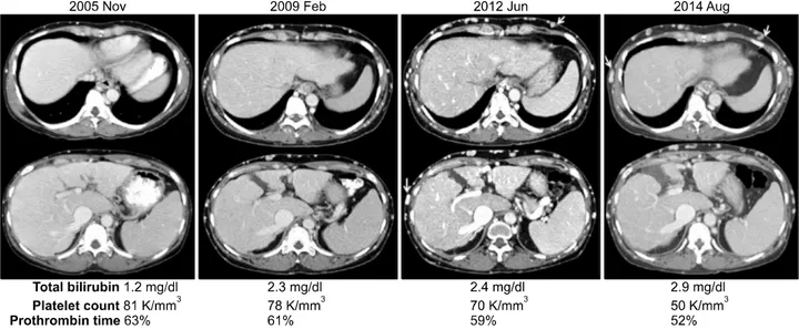Fig. 2. Computed tomography  images revealing the status of  the retrohepatic inferior vena  cava before (A) and after  endo-vascular stenting (B).