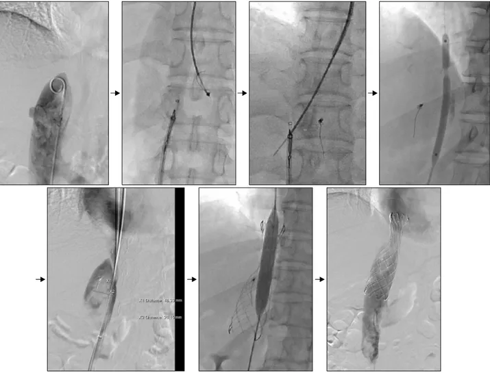 Fig. 3. Interventional endovascular stenting procedure for the inferior vena cava. The rendezvous technique was applied by assess- assess-ing the internal jugular vein and femoral vein
